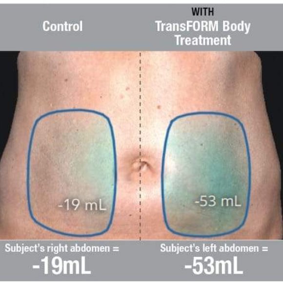 Alastin TransFORM Body Treatment with TriHex Technology